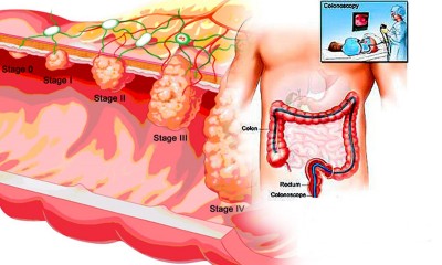 รูปมะเร็งลำไส้ใหญ๋1