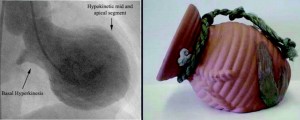 Takotsubo Cardiomyopathy